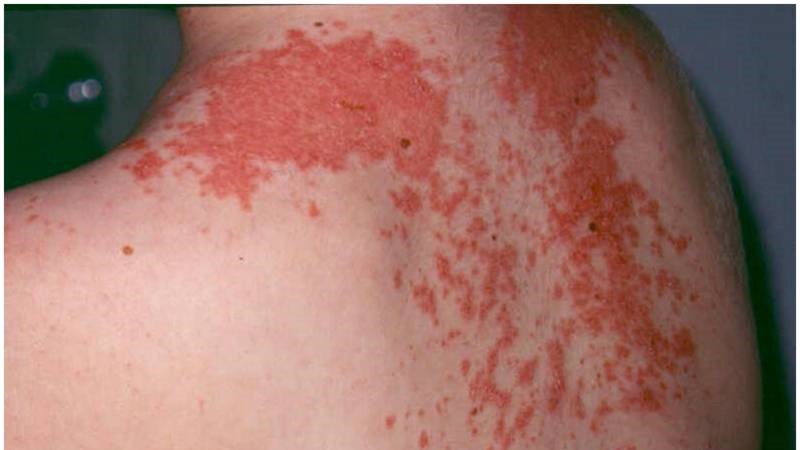 Maculopapular Rash 2